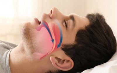 Guía Rápida para Entender la Apnea del Sueño