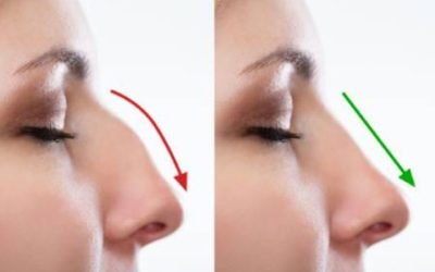 Los Beneficios de la Rinoplastia: Más que Estética