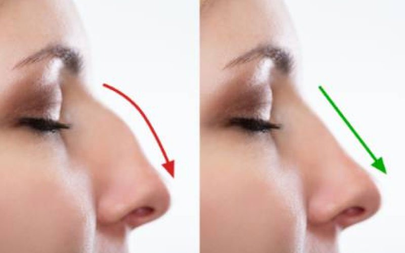 Los Beneficios de la Rinoplastia: Más que Estética